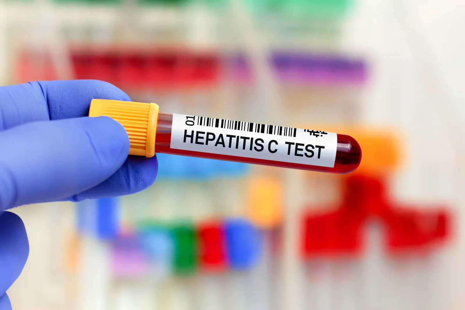 Hepatitt C-utslettelse: England nærmer seg ambisiøst mål