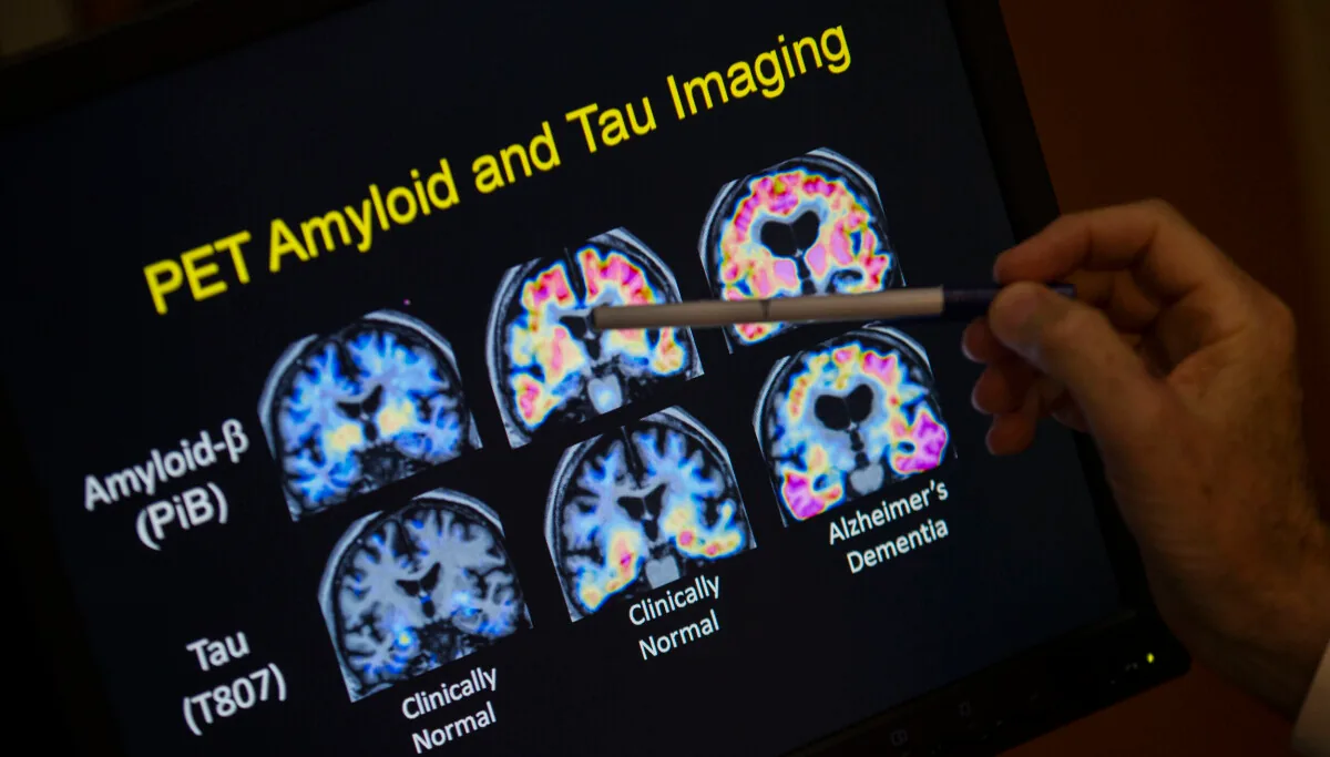 Nytt Alzheimers-funn gir håp om tidligere diagnose