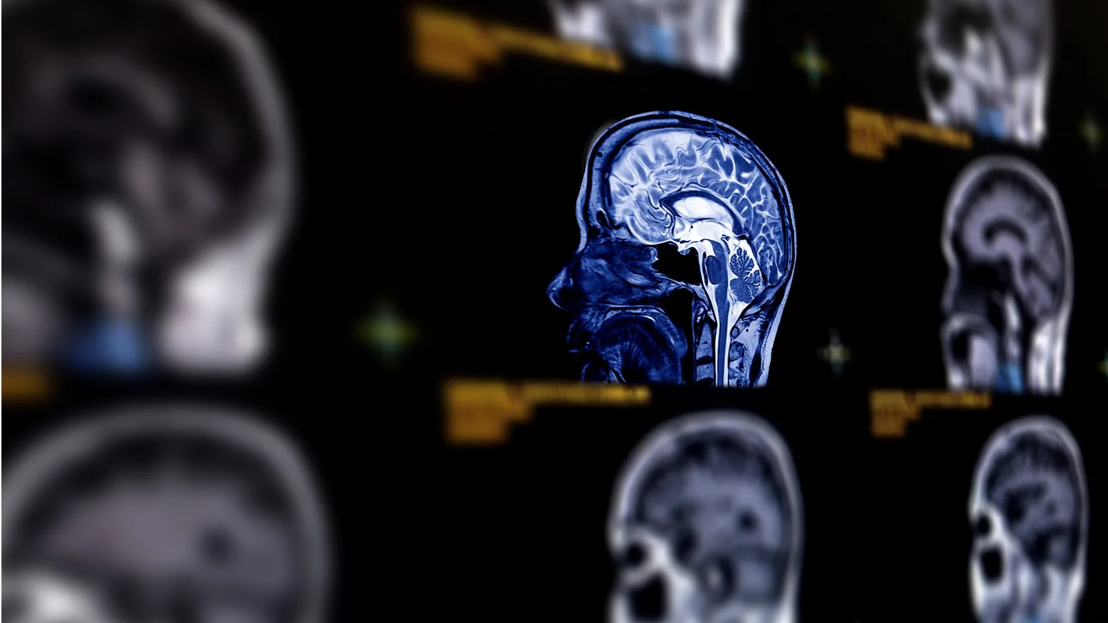 Parkinsons sykdom: Tidlige tegn og vekst i verden