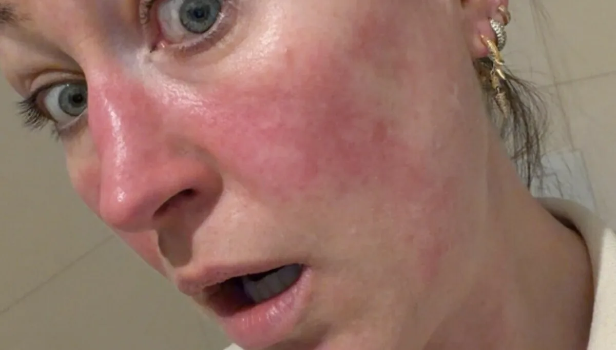 Stine Næss-Hartmanns vei ut av rosacea-plager