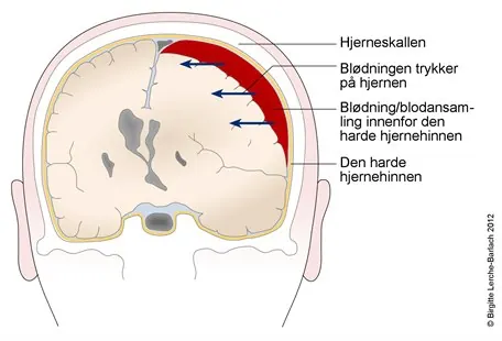 Nytt håp for kronisk subduralt hematom: Arterie-embolisering reduserer tilbakefall