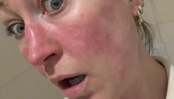 Stine Næss-Hartmanns vei ut av rosacea-plager